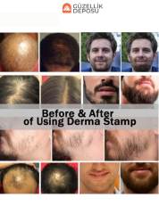 Ayarlanabilir Titanyum İğneli Dermastamp Dermaroller Cilt Ve Saç Yenileme Aparatı (0.25 - 3.0 mm)